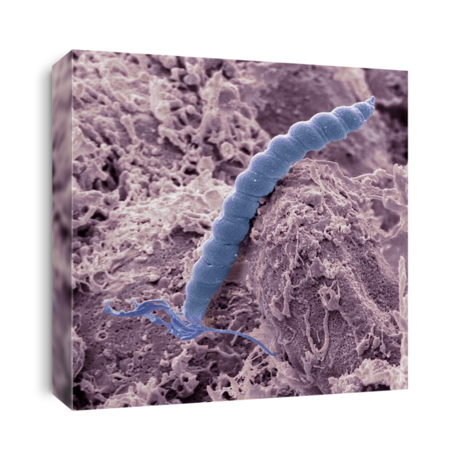 Helicobacter pylori bacteria. Coloured scanning electron micrograph (SEM) of a Helicobacter pylori bacterium (blue) in the stomach. H. pylori is a Gram-negative spiral-shaped bacterium found in the mucous lining of the stomach. It causes gastritis, and is also the most common cause of stomach ulcers. It may also be a cause or co-factor for gastric cancer as its presence increases the risk of developing stomach tumours. Magnification: x10,000, when printed 10cm wide.